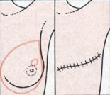 Простая мастэктомия Простая мастэктомия