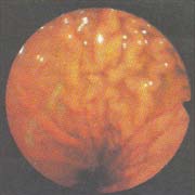 Эндоскопическая картина желудка