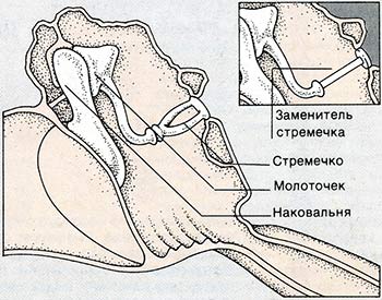 стапедэктомия