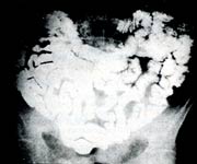 рентгенограмма кишечника