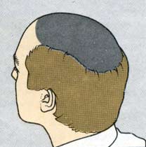 Пересадка волос