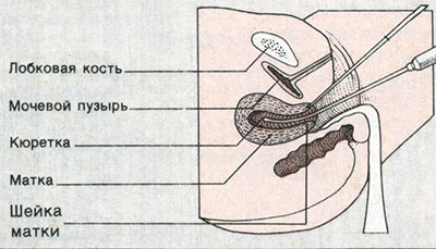 Выскабливание матки