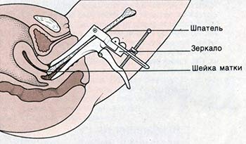 Кольпоскопия