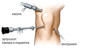 Артроскопическая хирургия
